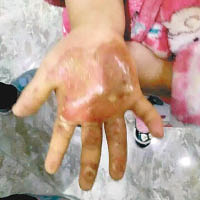 女童手掌被燙傷至長滿水泡。