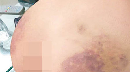 男童臀部瘀傷。（互聯網圖片）