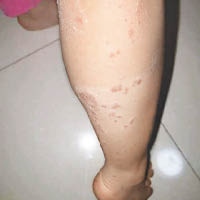 學童小腿及腳掌均現紅疹。