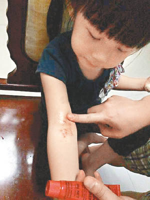 有學童四肢出現紅疹。（互聯網圖片）