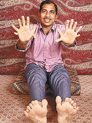 蘇塔爾天生患有多指畸形症。（互聯網圖片）