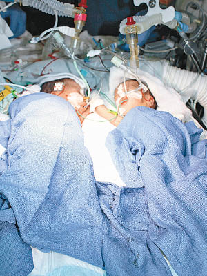 莉迪亞（左）和馬雅（右）相信是全球最年輕分割成功的嬰兒。（院方圖片）