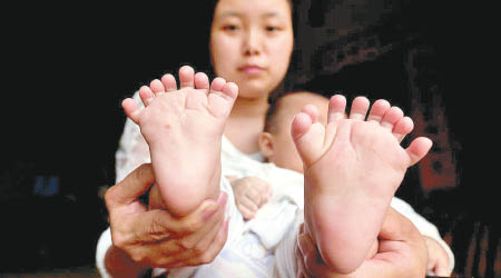 弘弘天生長有三十一隻手指及腳趾。（互聯網圖片）