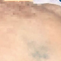 徐賢飛的遺體有大片瘀青和傷痕。