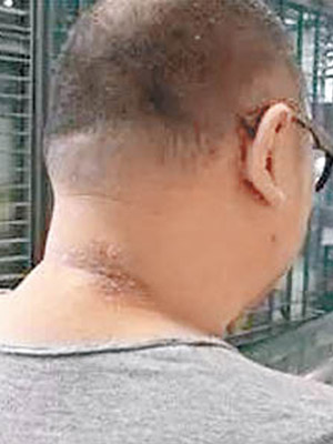吳先生頸部的皮膚潰爛。