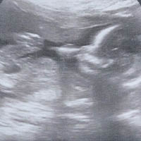 超聲波照片顯示另一個胎兒仍在子宮內健康成長。