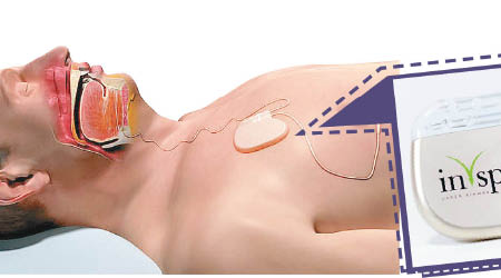 體積細小的起搏器會植入患者體內。