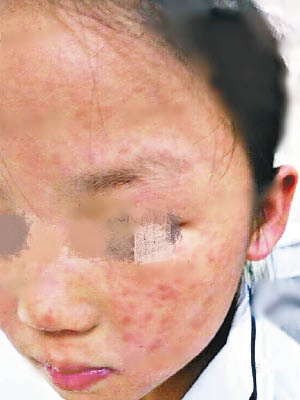 女學生面部出紅疹。（互聯網圖片）