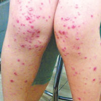 腺病毒可導致皮膚出紅疹。（互聯網圖片）