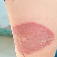 有女子腿部被鹽酸潑到，出現腐蝕性損傷。