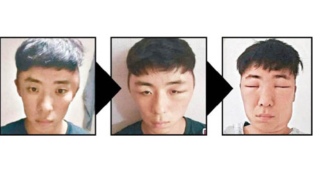 男子用了染髮劑後，面部現腫塊更蔓延至整個頭部。