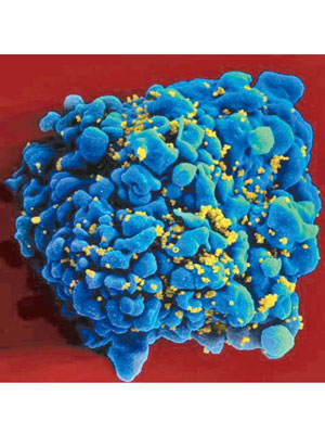 新療法可以消滅受愛滋病毒感染的細胞。