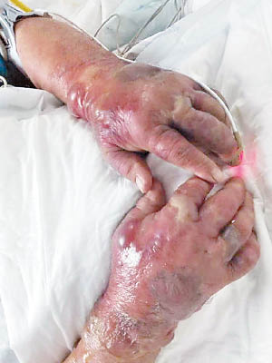 蘇男雙手被蟹箝傷後即出現紅腫出血徵狀。（互聯網圖片）