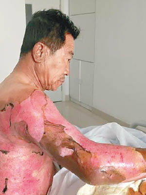 菲菲祖父亦遭燒傷。（互聯網圖片）