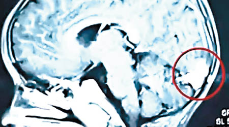 X光片顯示男童的大腦被「吃」出一個空洞（紅圈示）。