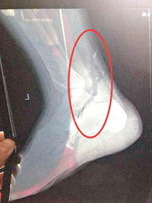 X光片顯示左側距骨內側緣出現撕脫性骨折。