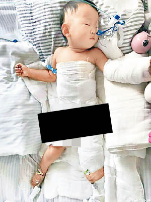 女童被嚴重燙傷，需在深切治療部留醫。（互聯網圖片）
