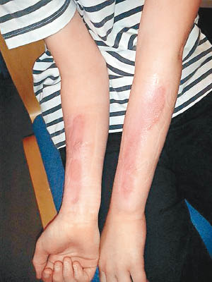 英國有少女玩鹽冰挑戰，令手臂留下永久傷痕。（互聯網圖片）