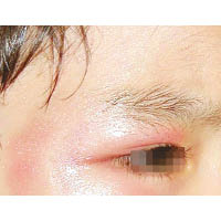 梁童眼部被打至紅腫。（互聯網圖片）