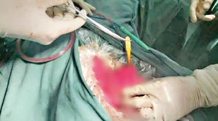 醫生為女子進行剖腹手術，將牙刷取出。（互聯網圖片）