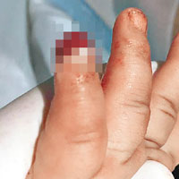 卡梅倫的手指受到永久性損傷。（互聯網圖片）
