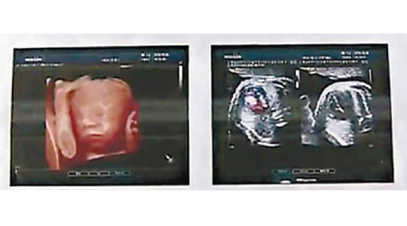 超聲波檢查顯示胎兒一切正常。（電視畫面）