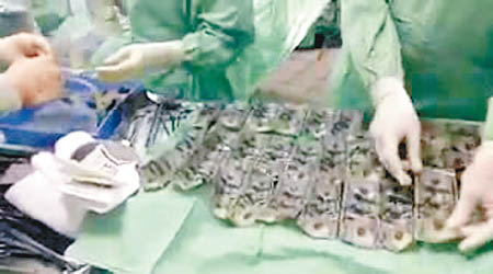 醫生從艾爾梅達的胃部取出部分紙幣。（互聯網圖片）