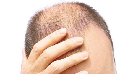 科學家發現一種免疫細胞或可治禿頭。
