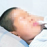 新疆小童早前被牙籤弩射盲右眼。