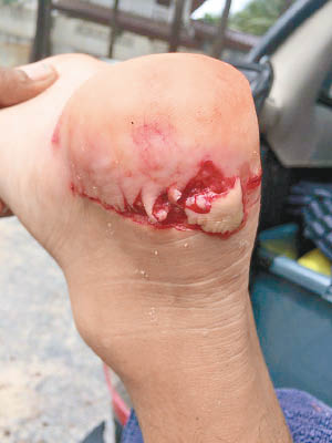 傷者腳部出現多道傷痕。