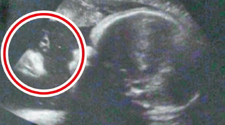 齊克的超聲波照中，左邊可見一個似是耶穌的影像（紅圈示）。（互聯網圖片）