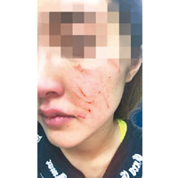鄧丹娜臉上有多道傷痕。（互聯網圖片）
