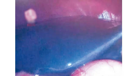 小劉的肝臟明顯變藍。（互聯網圖片）