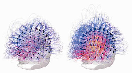植物人的腦部在手術後（右）更為活躍。（互聯網圖片）