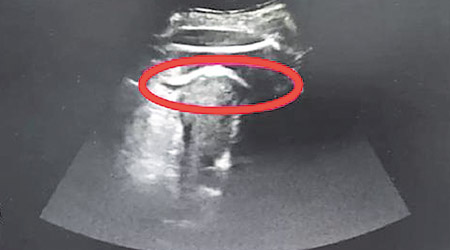 超聲波檢查發現，胎兒的腿（紅圈示）伸到子宮壁外。