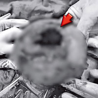 張婦的子宮出現一個七厘米的傷口（箭嘴示）。