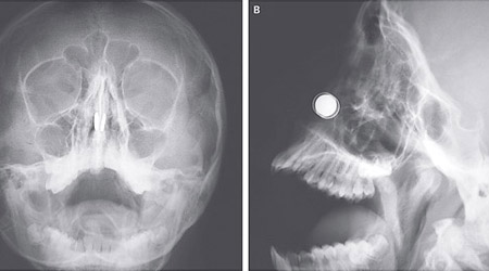 X光照片顯示男童鼻腔內的磁石。（《新英倫醫學雜誌》圖片）
