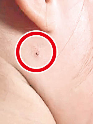 幼童身上有紅點狀傷痕（紅圈示）。（互聯網圖片）