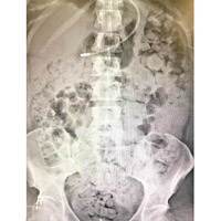 X光片可見，約曼身體積聚不少糞便。