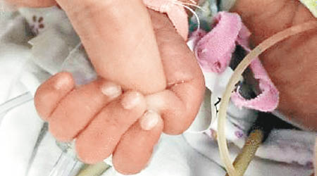 男嬰緊緊握住麻醉師的手指。（互聯網圖片）