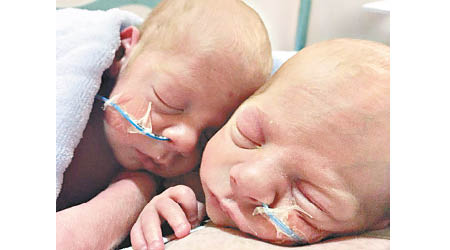 芬利（左）和哈利森（右）為同卵雙胞胎。