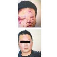 上及下圖：有警員被打至面部多處瘀傷。（互聯網圖片）
