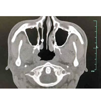 透過鼻腔影像可以看到，患者鼻腔黏膜糜爛。（互聯網圖片）