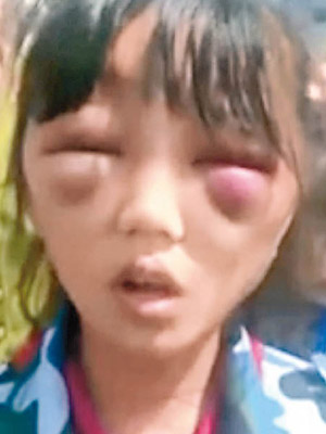 黑龍江女童被繼母毆打，雙眼嚴重腫脹。（互聯網圖片）