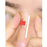 第二次手術後，汪女的鼻子出現一邊高、一邊低的狀況。