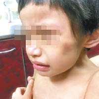 男童面上有瘀青的舊傷。（互聯網圖片）