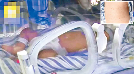 男嬰身體遍布針孔，被送入深切治療部搶救。