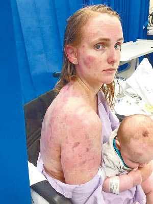 辛普森（左）以身護愛女，後背布滿瘀青和傷痕。（互聯網圖片）