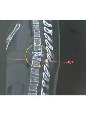 女病人胸椎骨折。（互聯網圖片）