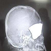 影像檢查發現，鐵塊嵌入頭部。